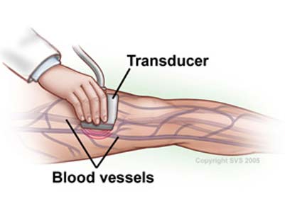 Image: diagram of doppler ultrasound scanning of leg blood vessels.